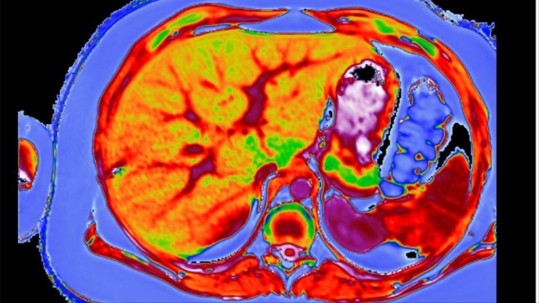 A handout combination image of MRI scans shows a healthy liver (bottom) compared with that of an obese 12-year-old suffering from NASH (nonalcoholic steatohepatitis), captured using Perspectum Diagnostics' Liver MultiScan technology in Oxford, England released on March 13, 2015. A healthy liver shows primarily in dark green. The mostly red liver indicates the presence of fat deposits. As drugmakers develop new medicines to battle a liver disease epidemic, they have created an urgent need for better diagnostics to select patients for treatment and assess their drugs' effectiveness. About 30 percent of people in the U.S. now suffer from fatty liver diseases, such as NASH, fueled by obesity, diabetes and over-indulgent lifestyles, according to the American Liver Foundation. Without treatment, sufferers can develop advanced damage, including the scarring known as fibrosis; cirrhosis, which destroys liver function; and even cancer. To match Insight LIVER-DIAGNOSTICS/ REUTERS/Perspectum Diagnostics Ltd/Handout via Reuters (UNITED KINGDOM - Tags: HEALTH SCIENCE TECHNOLOGY DRUGS SOCIETY) ATTENTION EDITORS - THIS PICTURE WAS PROVIDED BY A THIRD PARTY. REUTERS IS UNABLE TO INDEPENDENTLY VERIFY THE AUTHENTICITY, CONTENT, LOCATION OR DATE OF THIS IMAGE. FOR EDITORIAL USE ONLY. NOT FOR SALE FOR MARKETING OR ADVERTISING CAMPAIGNS. NO SALES. NO ARCHIVES. THIS PICTURE IS DISTRIBUTED EXACTLY AS RECEIVED BY REUTERS, AS A SERVICE TO CLIENTS