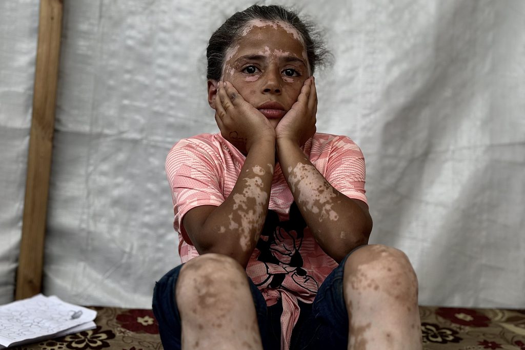 لانا.. طفلة فلسطينية شيبتها الإبادة الإسرائيلية