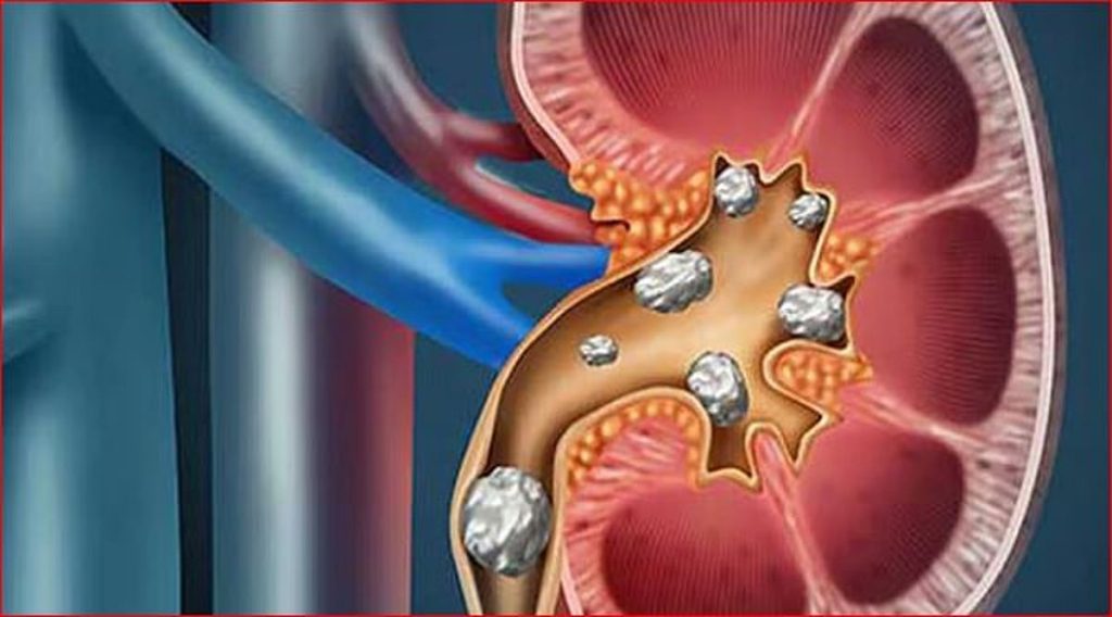 استشاري: ٥ عوامل تزيد من خطورة حصوات المرارة