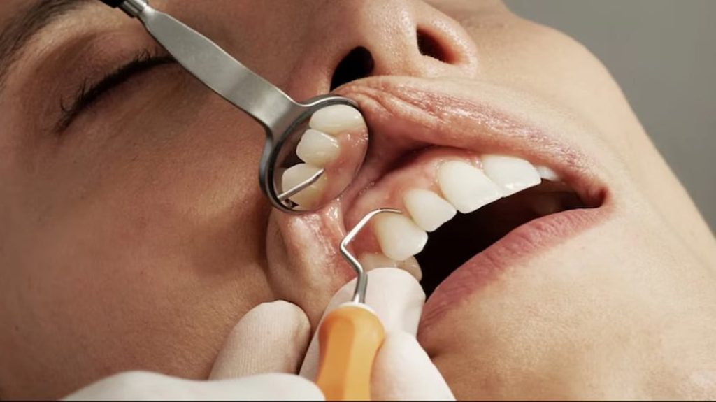 «أسنان أوزمبيك».. أحدث الآثار الجانبية المزعجة لدواء إنقاص الوزن