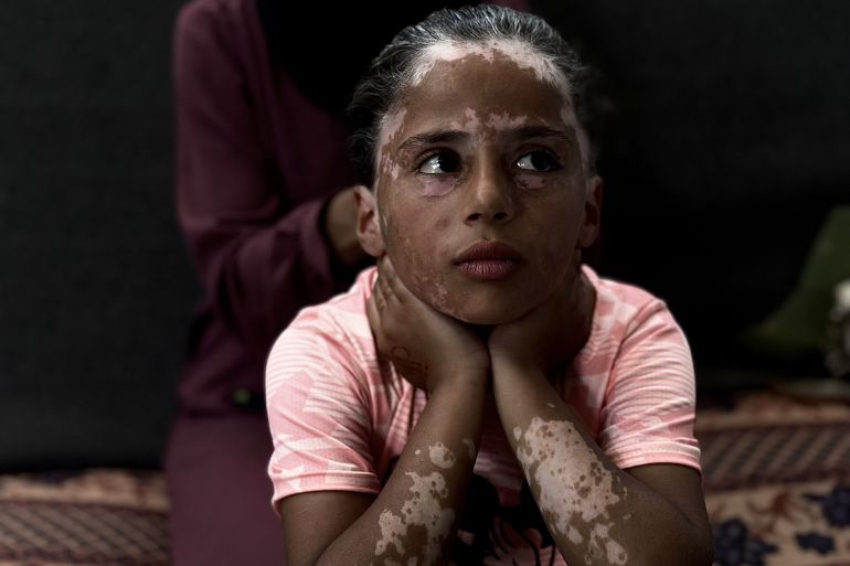 داخل خيمة مهترئة على أطراف أحد مخيمات النزوح بمدينة خان يونس جنوبي قطاع غزة، تجلس الطفلة الفلسطينية لانا الشريف متشبثة بما تبقى من طفولتها بعد 19 شهرا من حرب الإبادة الجماعية التي ترتكبها إسرائيل عاشت خلالها صدمات قاسية وأفقدتها معظم حقوقها. فلم ينجح القميص الوردي الذي ترتديه الشريف وطبع عليه شخصية "ميكي ماوس" الكرتونية في إضفاء قليل من الفرحة على ملامحها التي بدت مثقلة بالحزن بعدما وُشم جسدها بندوب بيضاء أشبه بمرض "البهاق" وفق تقدير أطباء بغزة. وعبر مرآة صغيرة، تتأمل الطفلة الشريف شكلها الذي غيرته حرب الإبادة الإسرائيلية المتواصلة إذ غزا شعرها "الشيب الأبيض" وهي لم تتجاوز سنواتها العشر بسبب تعرضها للخوف الشديد. ( Doaa Albaz - وكالة الأناضول )