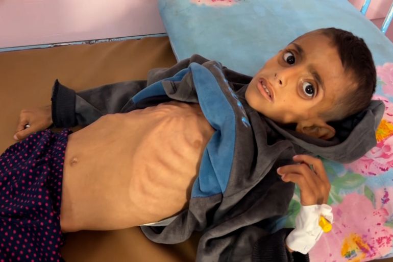 الجوع والمرض يفتكان بمئات الأطفال في غزة