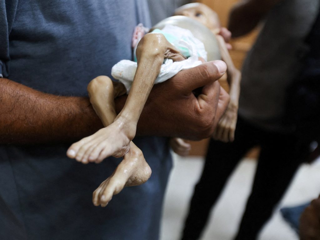 3 وفيات و95 إصابة بمتلازمة غيلان باريه النادرة في غزة بسبب التجويع