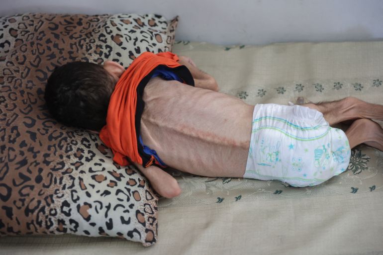 EDITORS NOTE: Graphic content / Palestinian four-year-old with cerebral palsy Ghassan al-Qishawi who also suffers from malnutrition due to the ongoing conflict between Israel and the Palestinian Hamas militant group in the Gaza, rests near his mother (not pictured) at their shelter at the UNRWA-run Salaheddin school in the Rimal neighbourhood of central Gaza City on June 10, 2024. (Photo by Omar AL-QATTAA / AFP)