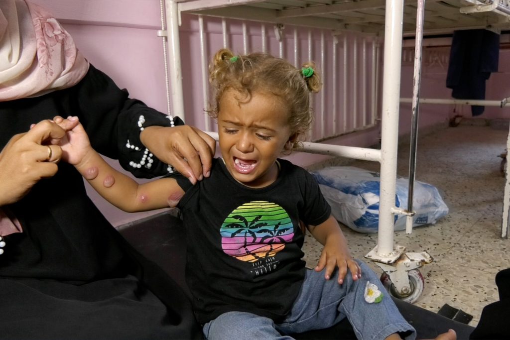 الطفح الجلدي ينهش أجساد الغزيين وصيدليات خاوية من كل دواء