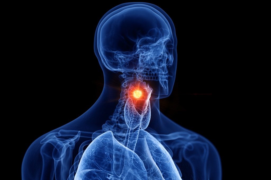 تطوير نماذج ذكاء اصطناعي للكشف المبكر عن سرطان الحنجرة