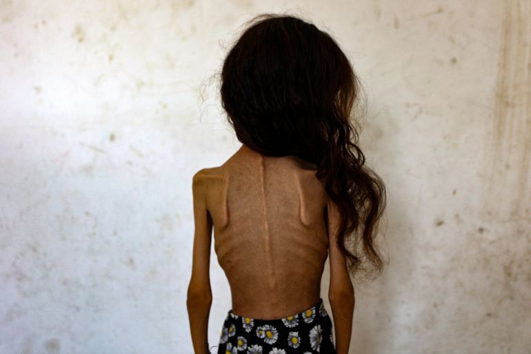 Nine-year-old malnourished Palestinian girl Mariam Dawwas stands against a wall in the Rimal neighbourhood in Gaza City on August 2, 2025. Dawwas' mother, Modallala, 33, who is living with her family in a displacement camp in the northern Gaza Strip, said her daughter had no known illness and weighed 25 kilograms before the war, but has now dropped to 10 kilograms. The World Health Organisation warned of on July 27 with malnutrition reaching "alarming levels" in Gaza. (Photo by Omar AL-QATTAA / AFP)