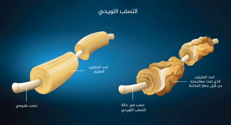 ***داخليه**** Illustration showing the multiple sclerosis إنفوغراف التصلب اللويحي Multiple sclerosis MS ويعرف أيضا باسم التصلب المتعدد التصلب العصبي المتعدد