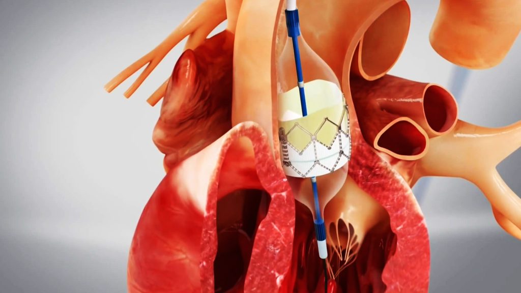 النوبات القلبية قد يكون سببها عدوى بكتيرية في الشرايين