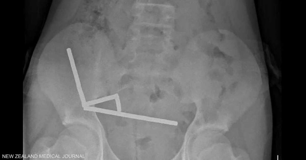 صبي يبتلع 100 مغناطيس اشتراها من “تيمو”.. والشركة تعلق