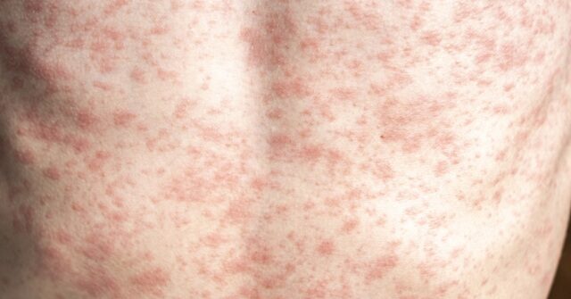 يحتاج آر إف كي جونيور إلى الدفاع “دون قيد أو شرط” عن لقاح الحصبة، ونقص التطعيم يسبب الوفيات وتفشي المرض